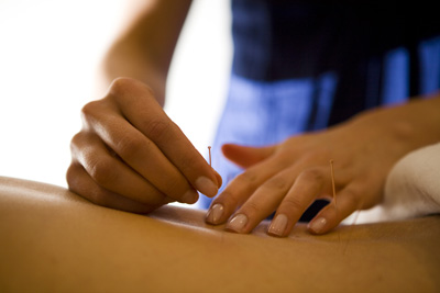 Acupuncture-2